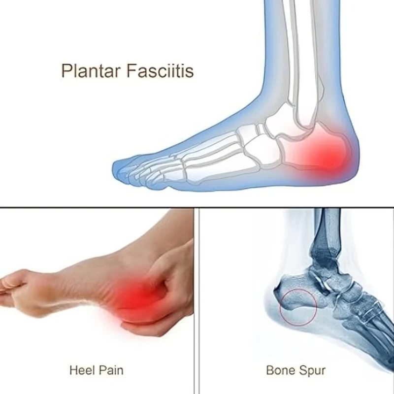 Miomu Plantilla de Talón para Fascitis Plantar